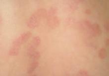 專家提醒患者認清初期無痛人流癥狀及時治療